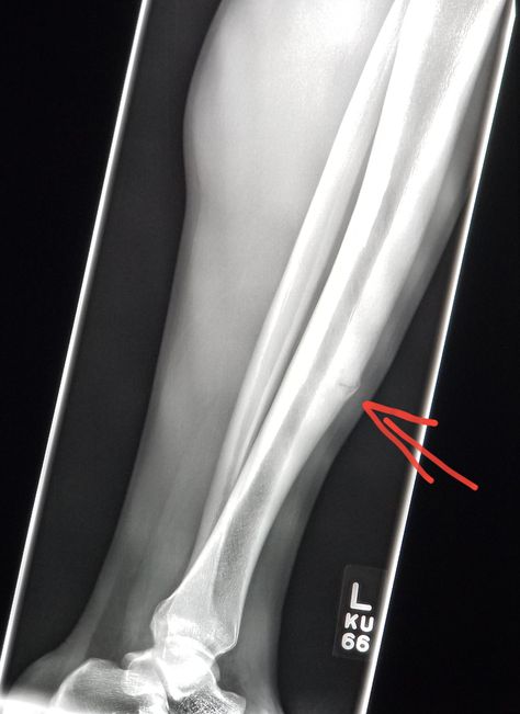 #Leg #Xray in a #runner shows #stress #reaction and #fracture. #radiologist #radiology #pain #injury Leg Xray, Hand Fracture, Happy Birthday Best Friend Quotes, Dark Beauty Photography, Leg Injury, Happy Birthday Best Friend, Leg Pain, Friend Quotes, Lower Leg