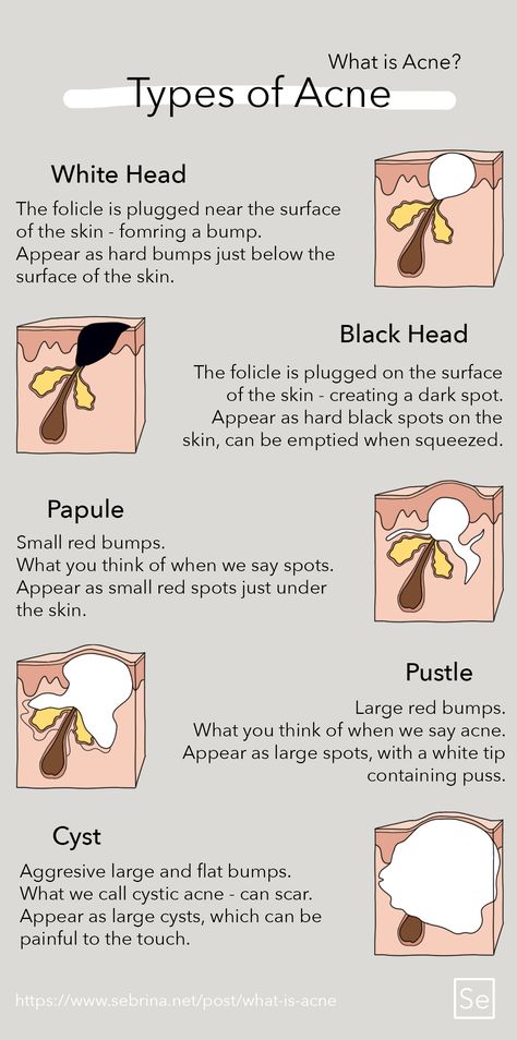 Papules Acne, Head Acne, Different Types Of Acne, Blind Pimple, Pimples Under The Skin, Bad Acne, Acne Overnight, Tips For Oily Skin, Oily Skin Acne