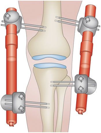 Alternative to Knee Replacement: Knee Joint Distraction – Howard J. Luks, MD Knee Pain Stretches, Knee Replacement Recovery, Knee Pain Relief Remedies, Knee Operation, Knee Pain Relief Exercises, Knee Strengthening Exercises, How To Strengthen Knees, Knee Problem, Knee Pain Exercises