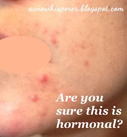 Adult Acne Tip : What you think is a stubborn hormonal breakout might not be! Find out more on the Acne Whisperer Blog. Chin Acne, Cystic Acne Remedies, Stubborn Acne, Hormonal Breakouts, Natural Acne Remedies, Home Remedies For Acne, How To Get Rid Of Pimples, Acne Problem, Acne Scar Removal