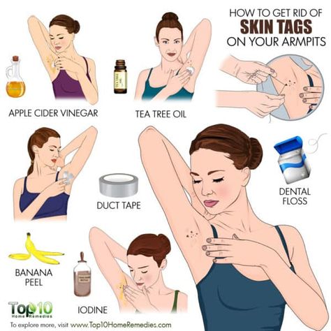 How to get rid of skin tags on armpit Skin Tags Apple Cider Vinegar, Skin Tags On Face, Clear Skin Overnight, Remove Skin Tags, Skin Improvement, Remove Skin Tags Naturally, Top 10 Home Remedies, Home Remedies For Skin, Skin Growths