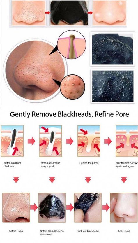 Warts On Face, Face Mask For Blackheads, Skin Moles, Get Rid Of Warts, Get Rid Of Blackheads, Rough Skin, Smokey Eye Makeup, Blackhead Remover, Face Scrub