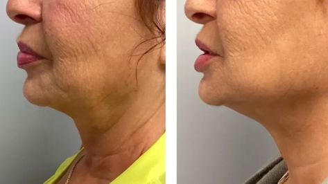 Microneedling Before and Afters: See How It Can Tighten the Neck, Smooth Scars + Regrow Hair Microneedling Before And After, Neck Tightening, Micro Needling, Androgenetic Alopecia, Regrow Hair, Derma Roller, Lost Hair, Glowing Complexion, Bright Skin