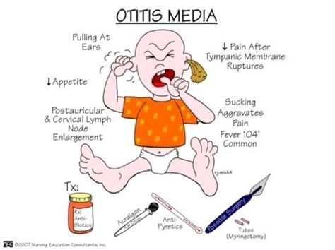 Otitis Media #pediatricnursing: Nursing Study Tips, Nursing Information, Nursing Mnemonics, Nurses Station, Nurse Midwife, Surgical Nursing, Medical Surgical Nursing, Nursing School Survival, Nursing School Studying