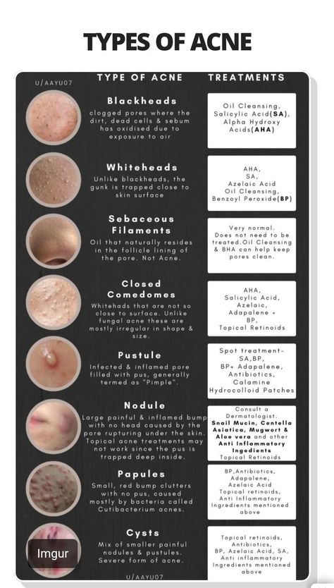 Homemade Acne Remedies, Different Types Of Acne, Skin Anatomy, Medical Esthetician, Medical Study, College Apps, Skin Facts, Skin Advice, Clear Healthy Skin