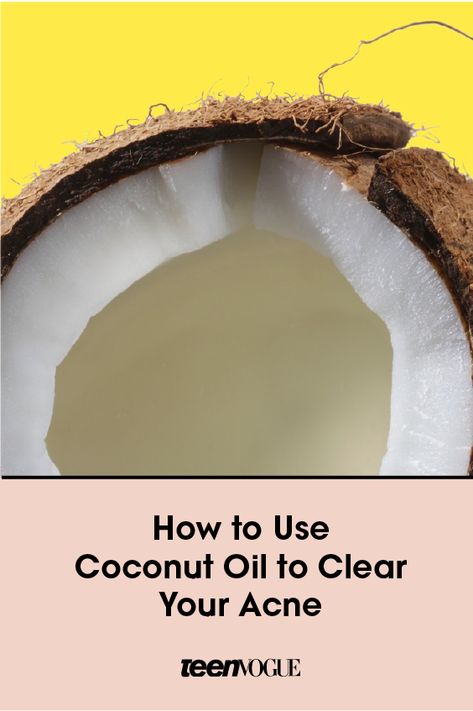 Clearing acne with coconut oil might not make a ton of sense logically, but it's actually a pretty effective tool. Here's how to use it to clear up zits. Clearing Acne, Clear Your Skin, Coconut Oil For Acne, Best Acne Products, Home Remedies For Acne, Cystic Acne, Things Under A Microscope, Healthy Bones, Glowy Skin