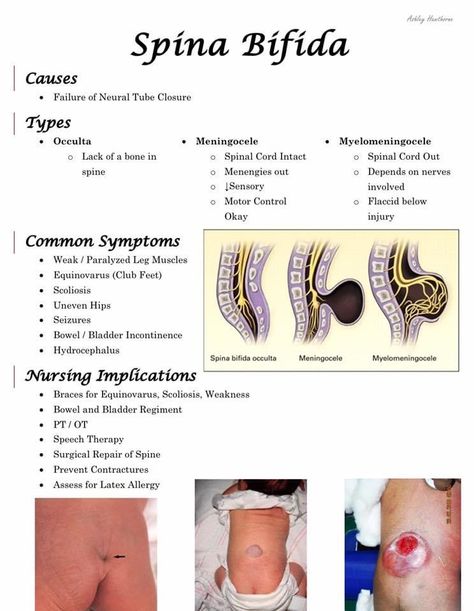 Fractures Nursing, Spinal Bifida, Pediatric Nursing Study, Medical Terminology Study, Nursing Study Tips, Medical Assistant Student, Nursing School Essential, Nursing School Motivation, Medical School Life