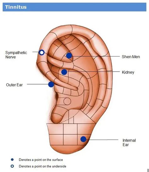 Unlocking the Power of Ear Seeds for Tinnitus Relief - Easy TCM Wisdom : Your Path to DIY Health and Wellness Ear Seed Placement, Ear Acupressure Points, Acupressure Points Chart, Ear Reflexology, Ear Seeds, Chronic Obstructive Pulmonary Disease, Restless Leg Syndrome, Liver Detoxification, Acupuncture Points