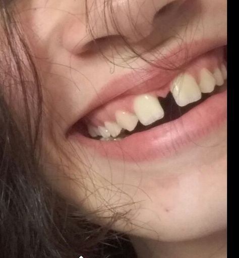 Tooth Gaps Aesthetic, Uneven Teeth Aesthetic, Missing Tooth Aesthetic, Gap Tooth Aesthetic, Tooth Gap Smile, Tooth Gap Drawing, Tooth Gap Aesthetic, Gap Teeth Aesthetic, Teeth Gaps Aesthetic