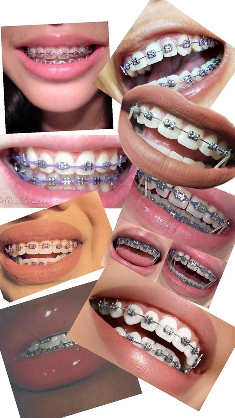 Maroon Braces Teeth, Braces Colors That Make Teeth Look White, How To Get Braces, Braces Aesthetic Colors, Powerchain Braces Color, Light Pink Braces, Braces Navy Blue, Brackets Aesthetic, Light Blue Braces