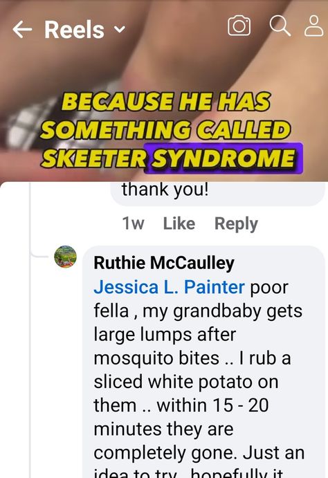 Skeeter Syndrome, Mosquito Bite, White Potatoes