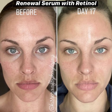 Retinol Guide, Tretinoin Before And After, Best Retinol Products, Make Pores Smaller, Before And After Acne, Healthy Skin Routine, Retinol Products, Roc Retinol Correxion, Best Retinol