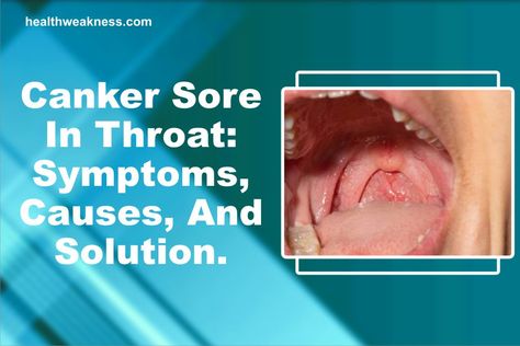 … Canker Sore In Throat: Symptoms, Causes, And Solution Read Post » What Causes A Canker Sore, Throat Ulcers, Canker Sore Causes, Canker Sore Remedy, Tongue Sores, Demodex Mites, Mineral Deficiency, Canker Sore, Viral Infection