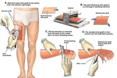 Skin grafting is a surgical procedure that restores and replaces the injured or diseased skin using healthy donor. Burn Injury, Bed Sores, Pressure Ulcer, Skin Grafting, Science Notes, Reconstructive Surgery, Deep Skin, Wound Care, Surgical Instruments