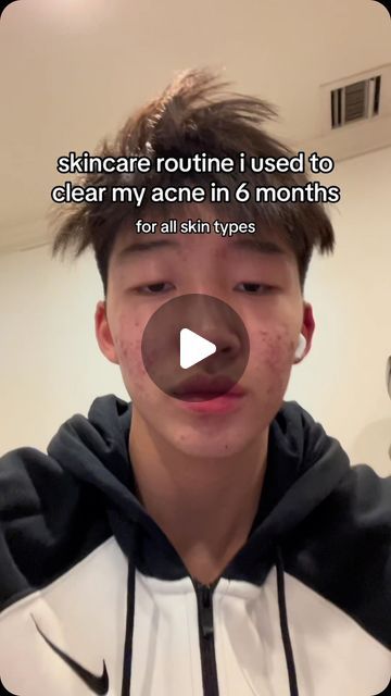 justin on Instagram: "9M on tiktok #koreanskincare #acne #acnejourney #acnetransformation #skin #foryoupage #korean #skincare #selfimprovement #blowthisup #realfood #clearskin #tiktok #xyzbca #goviral #fyp #tipsaccount" Skincare Routine For Hormonal Acne, Face Mask To Get Rid Of Acne, Skincare Routine For Acne Skin, Skincare Routine For Acne Prone Skin, Korean Skincare For Acne Prone Skin, How To Get Rid Of Hormonal Acne, Skincare Tips For Acne, Deep Clean Skin, Acne Prone Skin Care