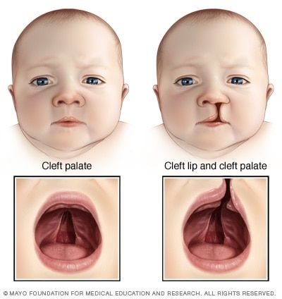 Digeorge Syndrome, Cleft Lip And Palate, Cleft Palate, Cleft Lip, Farmhouse Tile, Pediatric Nursing, Medical Knowledge, Body Anatomy, Upper Lip