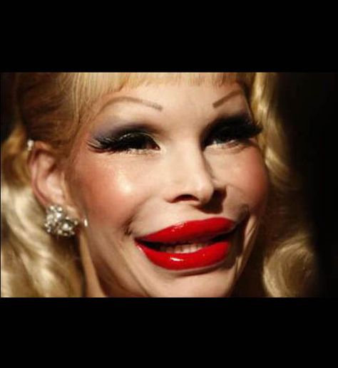 Plastic Surgery Pictures That Will Scare You Plastic Surgery Pictures, Bad Celebrity Plastic Surgery, Botox Results, Botched Plastic Surgery, Bad Plastic Surgeries, Julia Stegner, Plastic Surgery Fail, Amanda Lepore, Plastic Surgery Gone Wrong