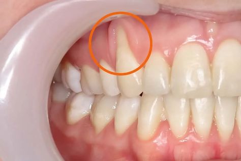 Reverse Receding Gums. In addition to gum disease, household… | by Isacsunsettid | Medium Reverse Gum Recession, How To Reverse Receding Gums, How To Heal Receding Gums, How To Strengthen Gums, Regrow Gums Natural Remedies, How To Repair Receding Gums, Inflamed Gums Remedies, Gum Diseases Chart, Receding Gums Remedies