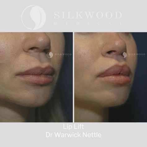 Lip lift surgery exposes more of your top lip making it appear fuller. With age the top lip drops which can look very ageing. Lip lift surgery rejuvenates your face by lifting up the top lip, delivering the appearance of fuller, youthful lips. Contact our team to find out more.⁠ ⁠ E: reception@silkwoodmedical.com.au⁠ ⁠ #lipliftsurgery #upperlipliftsurgery #modifiedlipliftsurgery #fullerlips #beautifullips #drwarwicknettle #plasticsurgeon #plasticsurgery #silkwoodmedical #sydneyplasticsurgeon Lipo 360 Before And After, Lip Lift Surgery, Lip Surgery, Breast Lift Surgery, Lip Lift, Botox Before And After, Face Surgery, Eyebrow Lift, Skin Tightening Treatments