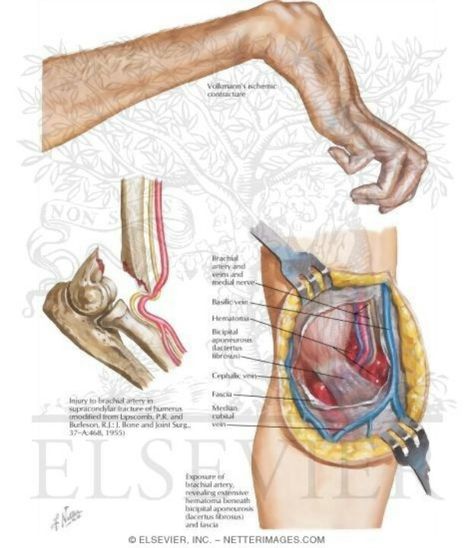 Volkmann's contracture can be caused by supracondylar fracture of the humerous Brachial Artery, Wrist Fracture, Humerus Fracture, Remedial Massage, Physical Therapist Assistant, Nclex Prep, Medical Procedures, Massage Center, Med Surg