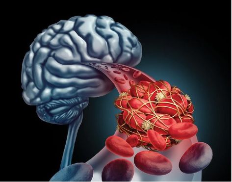 Stroke is the condition that occurs when the clot is formed in the artery and the oxygen supply to the brain is cut off, brain cells get deprived of oxygen and starts to die. Health Benefits Of Eggs, Egg Benefits, Brain Surgeon, Carotid Artery, Severe Headache, Normal Blood Pressure, Cornell University, Blood Flow, Diet And Nutrition