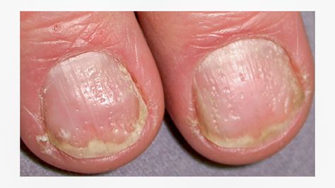 hard and rough nail surface with pitting Dents In Nails, Pitted Nails, Nail Disorders, Nail Discoloration, Nail Remedies, Nail Ridges, Nail Problems, Nail Vitamins, Nail Infection