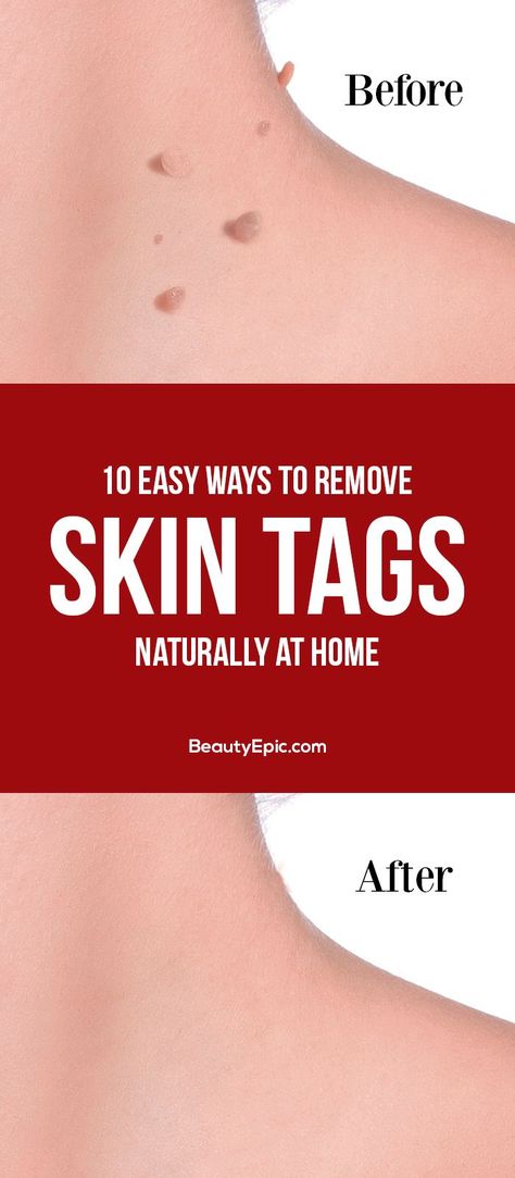 Home Remedies for Skin Tag Removal: To help one to remove these tags naturally, we have the most feasible ways to remove these tags at home Remove Skin Tags, Warts On Face, How To Remove Warts, Remove Skin Tags Naturally, Remove Warts, Home Remedies For Skin, Get Rid Of Warts, Skin Natural Remedies, Skin Tags