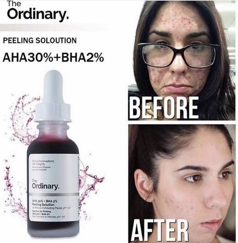 The Ordinary aha 30% bha 2% peeling solution before and after Aha Peeling Solution, Ordinary Peeling Solution, The Ordinary Peeling Solution, Peeling Solution, Acne Prone Skin Care, Best Acne Products, Deep Exfoliation, The Ordinary Skincare, Skincare Inspiration