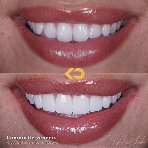 How incredible is this composite veneer makeover?! This patient was looking for a brighter more symmetrical smile. The Dr placed 10 composite veneers to complete the look. Book in for a FREE consultation at any of our clinics: 📍Manchester City centre 📍Flixton 📍Altrincham 📍Knutsford 📍Alderley Edge 📍Liverpool 📍Bramhall Head to kissdental.co.uk to get booked in Composite Bonding Before And After, Veneers Before And After, Composite Bonding Teeth, Composite Bonding, Dentist Art, Composite Veneers, Alderley Edge, Beautiful Teeth, Manchester City Centre