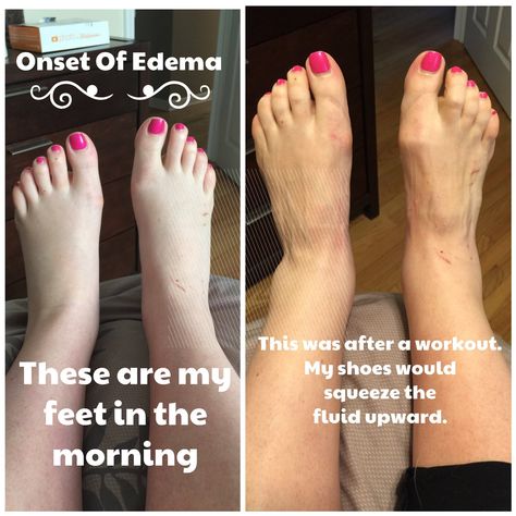 How to cope with pregnancy swelling and edema. Swelling Remedies, Pregnancy Swelling, Hangover Headache, Sunburn Peeling, Blogger Ideas, Swollen Ankles, Being Pregnant, Fluid Retention, Second Trimester