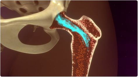 A team of researchers have identified the cellular network involved in initiating and maintaining chronic inflammation in rheumatoid arthritis. Blood And Bone, Bone Marrow, Chronic Inflammation, Blood Cells, Stem Cells, Bones