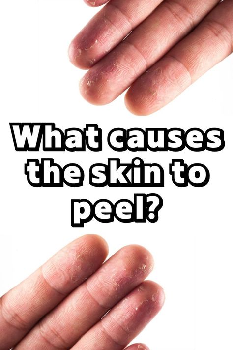 n this blog post, we will explore the various causes of finger peeling, as well as potential treatments and prevention methods. Skin Peeling On Hands, Peeling Fingertips, Natural Antifungal, Daily Hygiene, Vitamin Deficiency, Skin Hand, Health Heal, Hygiene Routine, Diy Cosmetics