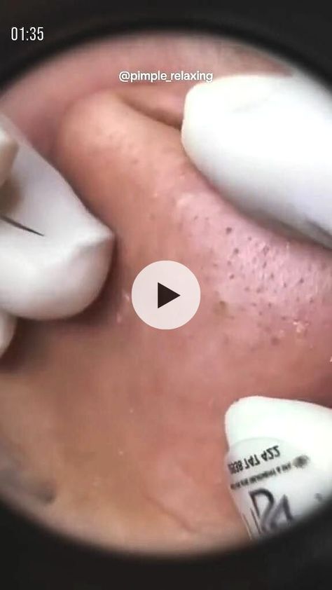 pimples popping video blackhead..!! Blackhead Removal Mask, Nose Pimples, Nose Blackheads, Blackheads Popping Videos Faces, Homemade Pore Strips, Organic Anti Aging Skin Care, Blackheads On Face, Remove Blackheads From Nose, Teeth Whitening Remedies