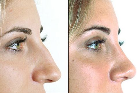 #ElanClinic #GrassValley #CA #PlasticSurgery #Before #After Plastic Surgery Recovery, Nonsurgical Nose Job, Rhinoplasty Nose Jobs, Rhinoplasty Before And After, Rhinoplasty Surgery, Perfect Nose, Nose Surgery, Neck Lift, Mascara Tips