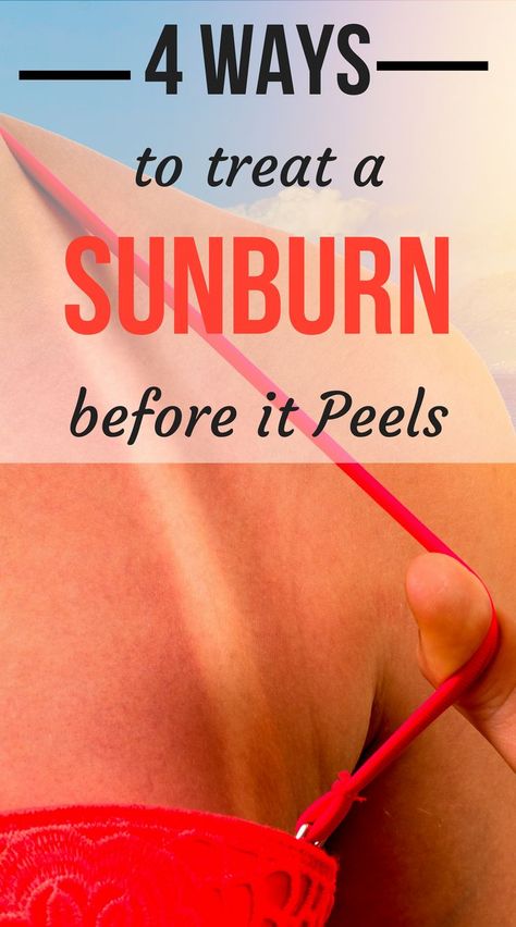 Find out how to treat a sunburn, help your skin heal, and how to keep it from peeling, on SHEFinds.com. Because no one wants to lose their tan! #beauty #fashion #style #skincare Sunburn On Face, Sunburn Face, Sunburn Blisters, How To Help Sunburn, Get Rid Of Sunburn, How To Treat Sunburn, Sunburn Peeling, Heal Sunburn, Bad Sunburn