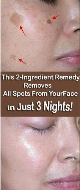 How to Get Rid of Dark Spots at Home Naturally Black Spots On Face, Bleaching Your Skin, Brown Age Spots, Brown Spots On Skin, Dark Spots On Face, Brown Spots Removal, Brown Spots On Face, Skin Spots, Spots On Face