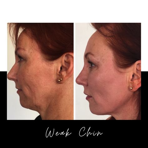 Feeling self-conscious about your weak chin? If you want a more chiselled jawline or defined profile, then you may have considered chin surgery. But what if there was a solution that avoided having to go under the knife AND offered you an immediate result? Check out our latest blog to find out more... Weak Jawline, Jawline Men, Chin Surgery, Weak Chin, Elite Aesthetics, Jaw Exercises, Long Beard Styles, Under The Knife, Receding Gums