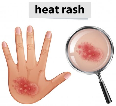 Human hand with heat rash | Premium Vector #Freepik #vector #background #hand #medical #cartoon Medical Cartoon, Heat Rash, Superbowl Party Food, Skin Diseases, Human Hand, Superbowl Party, Emotional Health, Vector Background, Premium Vector