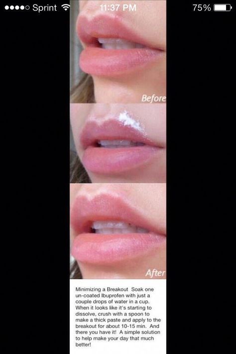 Remove A pimple next to lip less than 20 MinutesLike Please ☺️ #NaturalSleepRemedies Lip Pimple, Cleopatra Beauty, Skin Care Center, Forehead Acne, Pimples Under The Skin, Natural Skincare Recipes, Antiaging Skincare Routine, How To Get Rid Of Pimples, How To Get Rid Of Acne