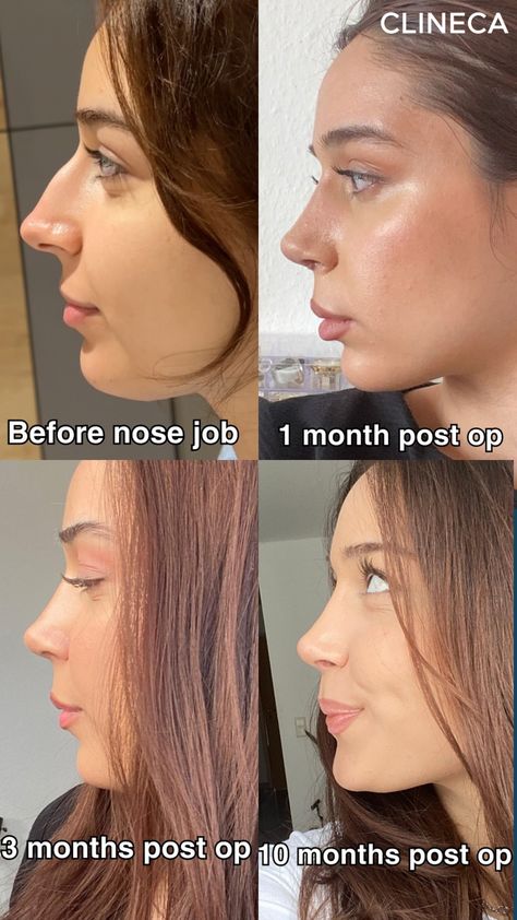 👃 1 Month: Swelling starts to go down, and the new shape is becoming more defined, but patience is key! You’ll notice changes daily.  💫 3 Months: Significant progress! Most of the swelling has subsided, and you’ll start seeing the final shape of your nose. Time to enjoy the results! 🌟  🌿 6 Months: Full healing and refinement of your nose's appearance. Your new look is here to stay! 🙌  Trust the process & enjoy your transformation! 💖 #NoseJob #Rhinoplasty #BeforeandAfter Side Profile Before And After, Rhinoplasty Results, Best Nose Shape, Turkey Nose Job, Subtle Nose Job, Nosejob Rhinoplasty Before After, Lower Blephoraplasty Before And After, Beautiful Nose Shape, Sculptra Before And After