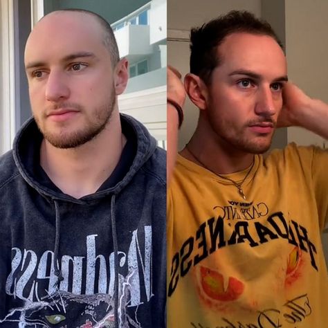 TikTok influencer who started losing hair at 19 breaks stigma around male hair loss - Good Morning America Losing Hair, Hair Growth For Men, Tiktok Influencer, Male Hair, Lost Hair, Hair Regrowth, Hair Restoration, Beauty Standards, Good Morning America