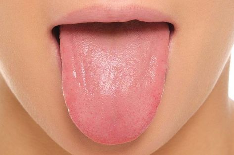 15 Common Tongue Diseases That Can Affect You Tongue Problems, Healthy Tongue, White Tongue, Red Tongue, Dry Mouth, How To Get Rid Of Pimples, White Patches, Oral Hygiene, Total Body