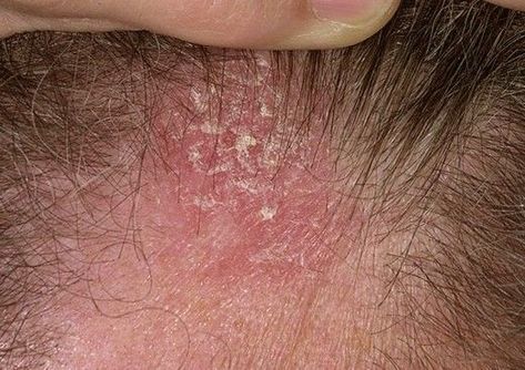 Skin Tags On Face, Thicker Hair Remedies, Warts On Hands, Diseases And Disorders, Losing Hair, Thick Hair Remedies, Hair Growth Remedies, Dandruff Remedy, Luxury Hair Care