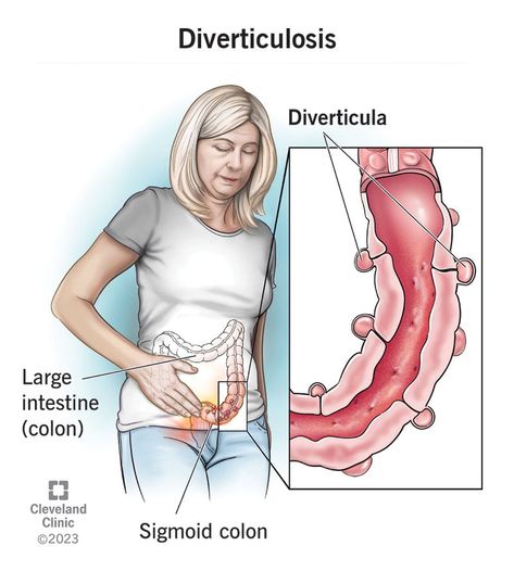 Diverticulosis Diviticulitis Diet, Lower Abdominal Pain, Sigmoid Colon, Reflux Disease, Human Body Anatomy, Pelvic Floor Exercises, Medical Knowledge, Body Anatomy, Chronic Inflammation