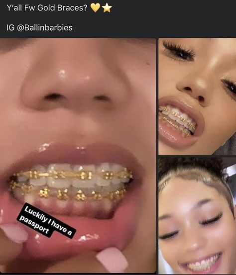 Gold Braces, Cute Braces Colors, Pretty Teeth, Braces Tips, Grillz Teeth, Getting Braces, Cute Braces, Brace Face, Braces Colors