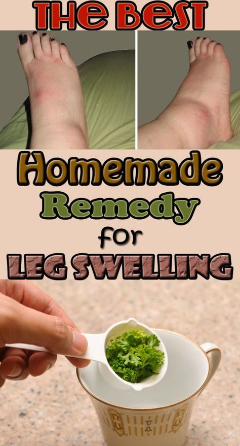 Swelling Remedies, Leg Swelling, Water Retention Remedies, Cold And Cough Remedies, Fluid Retention, Body Fluid, Holistic Remedies, Homemade Recipe, Physical Pain