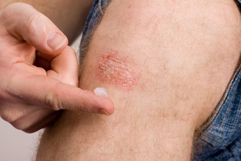 7 Causes of Red Spots and Bumps on Skin, With Pictures | Allure Red Rashes On Skin, Skin Rashes Pictures, Leg Rash, Red Skin Spots, Fungal Rash, Red Rash, Skin Moles, Heat Rash, Skin Bumps