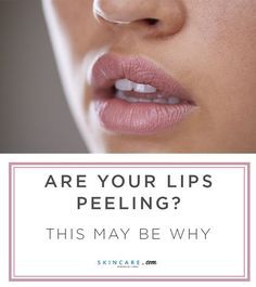 From what causes our lips to peel in the first place to how we can prevent this from happening we're sharing expert tips for achieving smooth lips. #beauty #makeup #skincare #lipcare Dry Skin Causes, Lips Peeling, Pale Lips, Medical Esthetician, Dry Cracked Lips, Cream For Oily Skin, Dry Skin Body, Cracked Lips, Peeling Skin