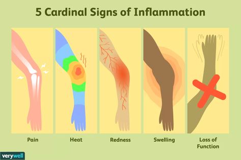 What Are the 5 Cardinal Signs of Inflammation? Musculoskeletal Disorders, Cardinal Signs, Home Remedies For Bronchitis, Cushings Syndrome, Signs Of Inflammation, Body Inflammation, Low Estrogen Symptoms, Too Much Estrogen, Inflammation Causes