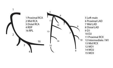 Coronary anatomy - PCIpedia Coronary Arteries Anatomy, Cath Lab Technician, Cardiovascular Technologist, Cath Lab Nursing, Cardiac Cath, Cath Lab Nurse, Coronary Circulation, Heart Catheterization, Arteries Anatomy